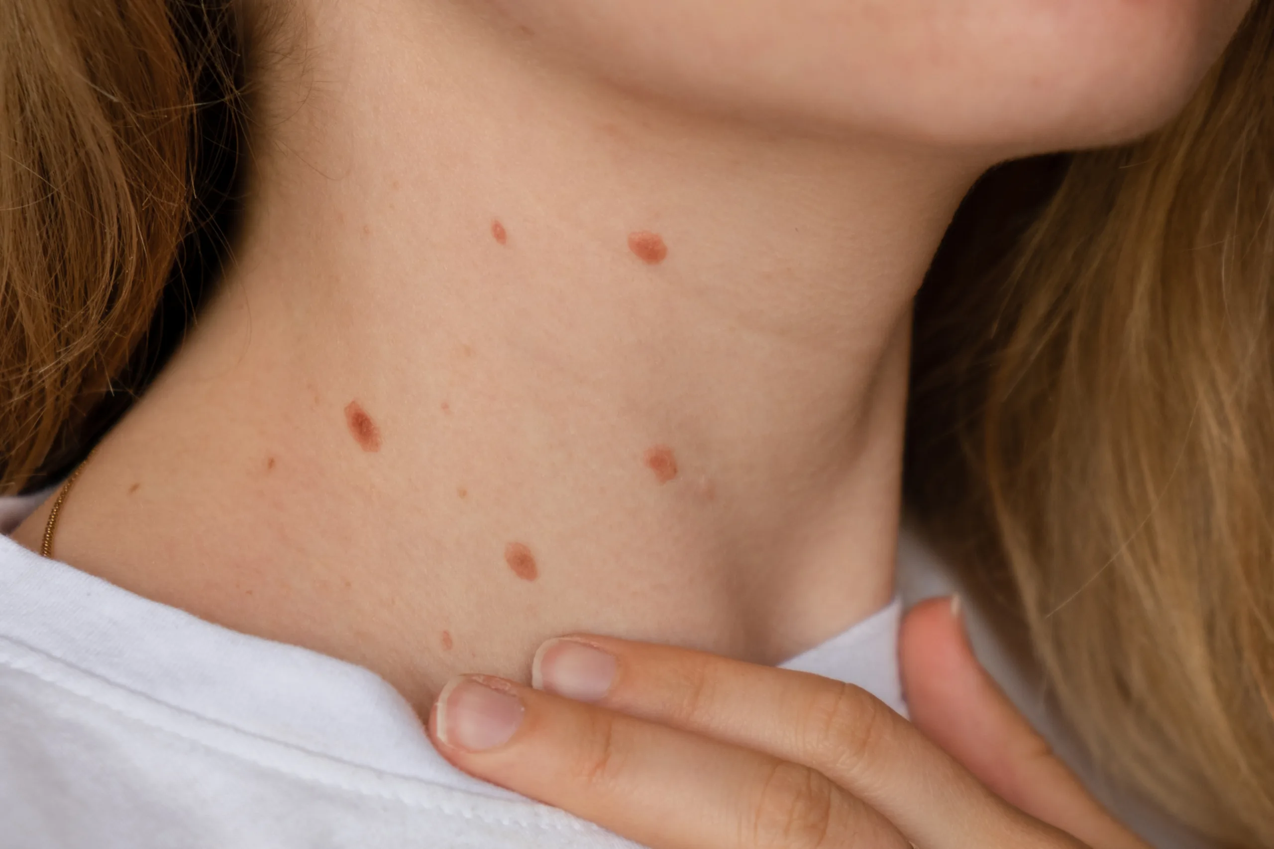 Laser Treatment for Body Pigmentation