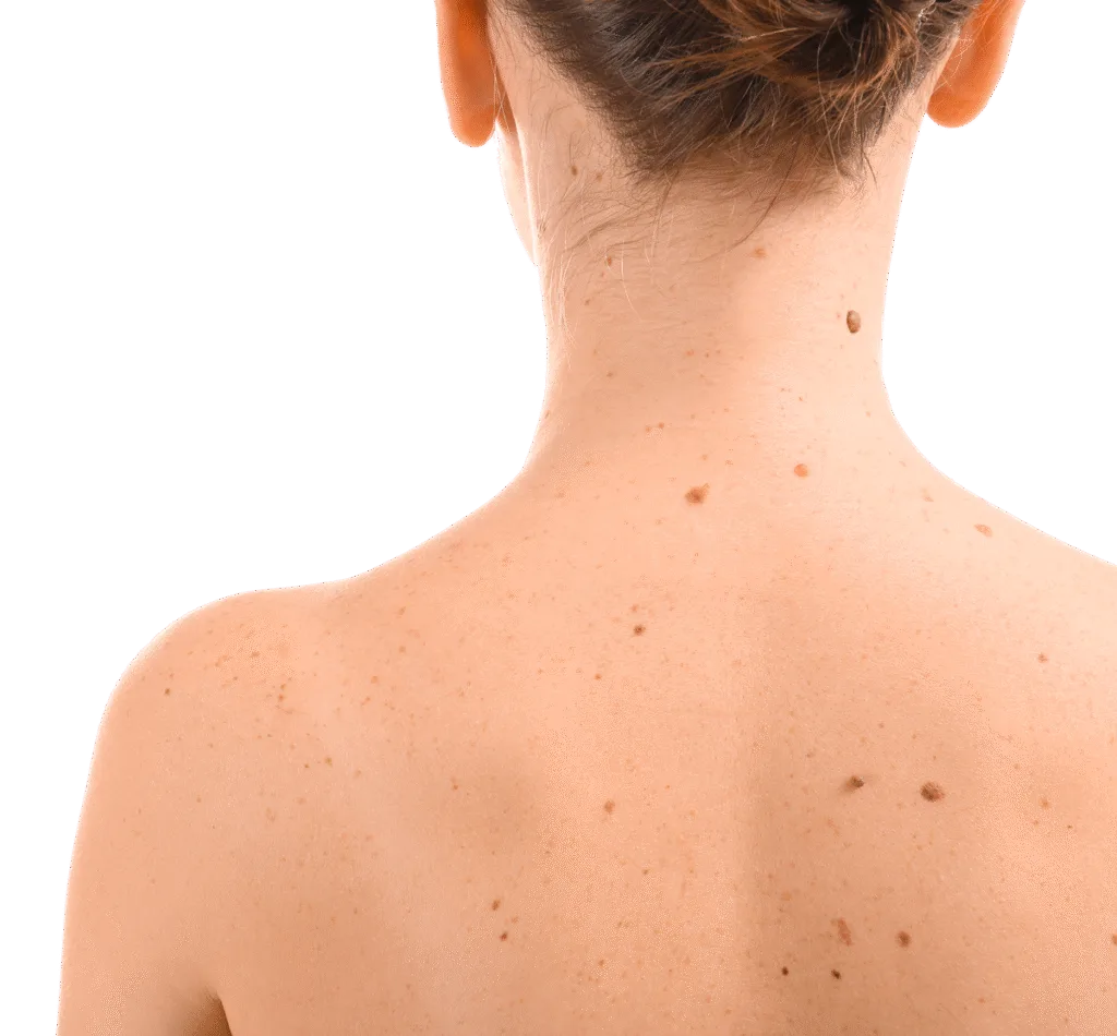 Laser Treatment for Body Pigmentation
