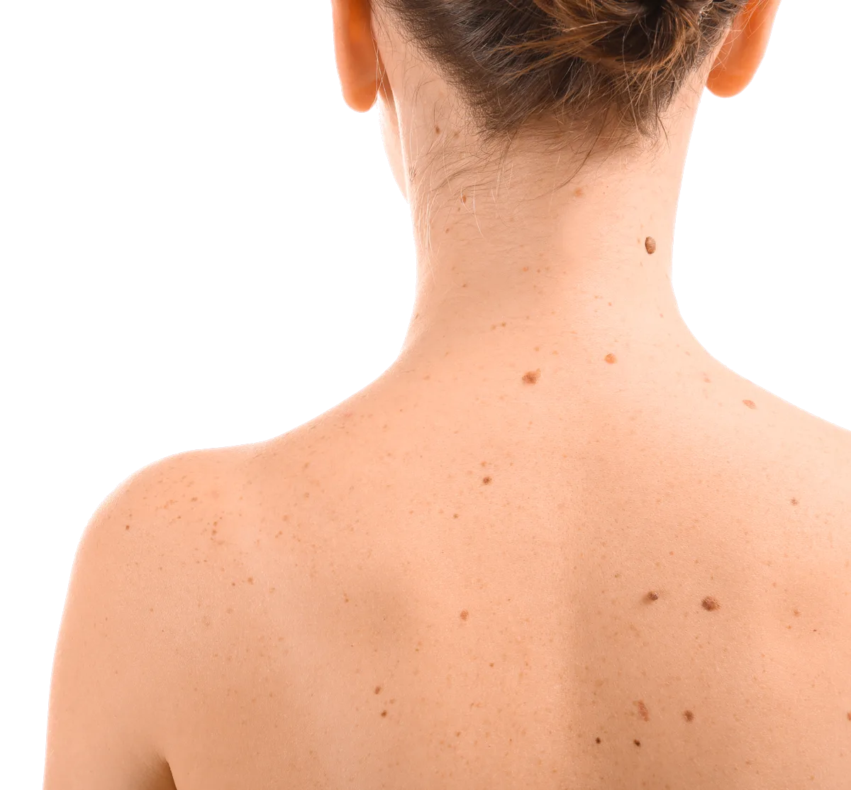 Laser Treatment for Body Pigmentation